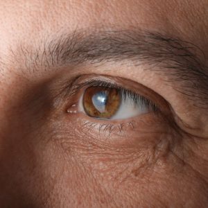 Pathologie : cataracte